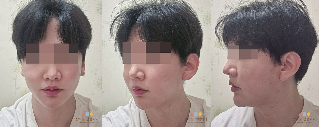 수술 후
