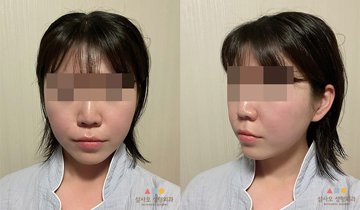 수술 후