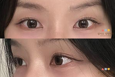 수술 후