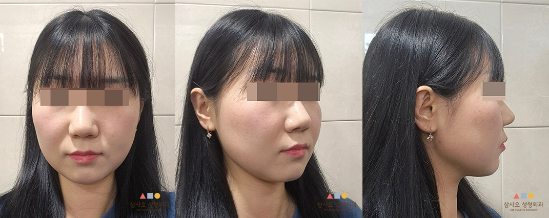 수술 전