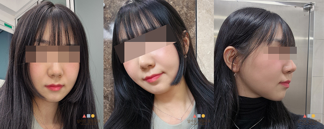 수술 후