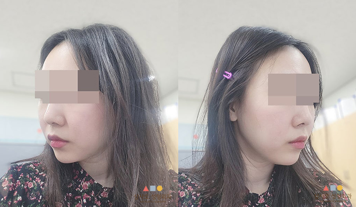 수술 후