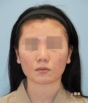 수술 전