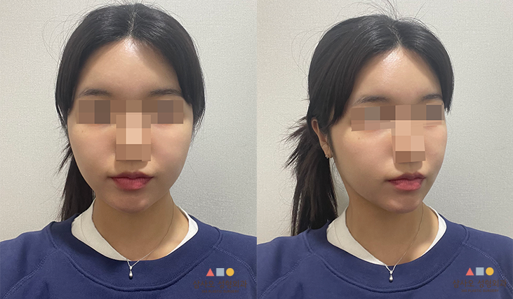 수술 후