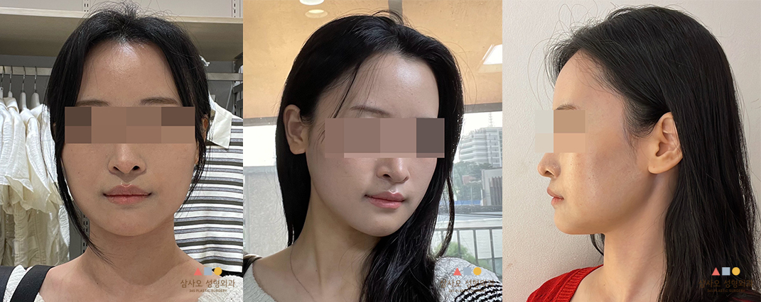 수술 후