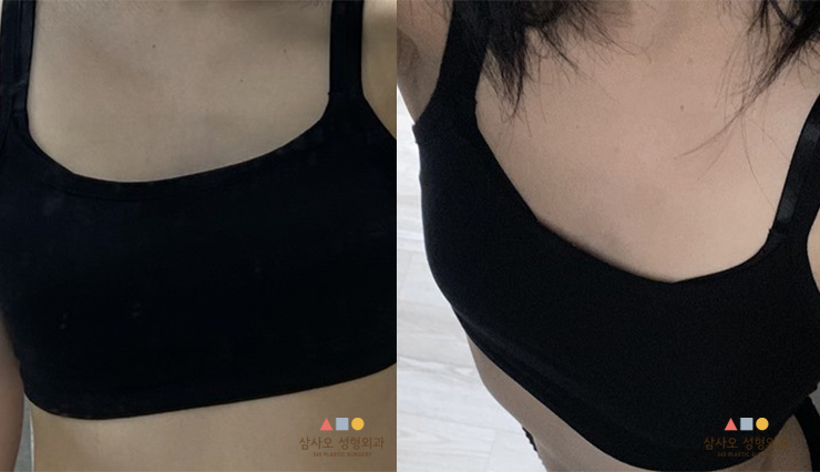 수술 전