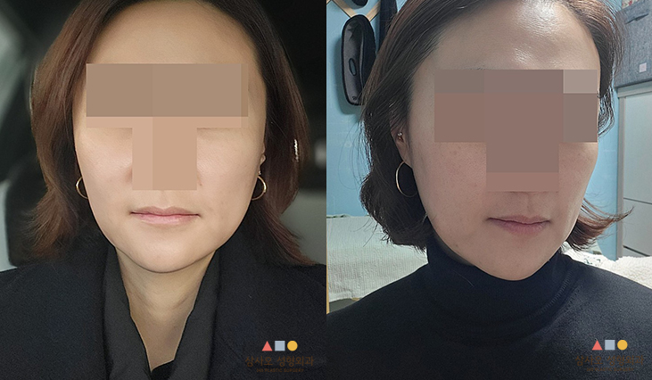 수술 후