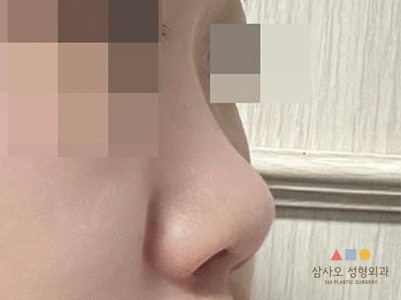 수술 전