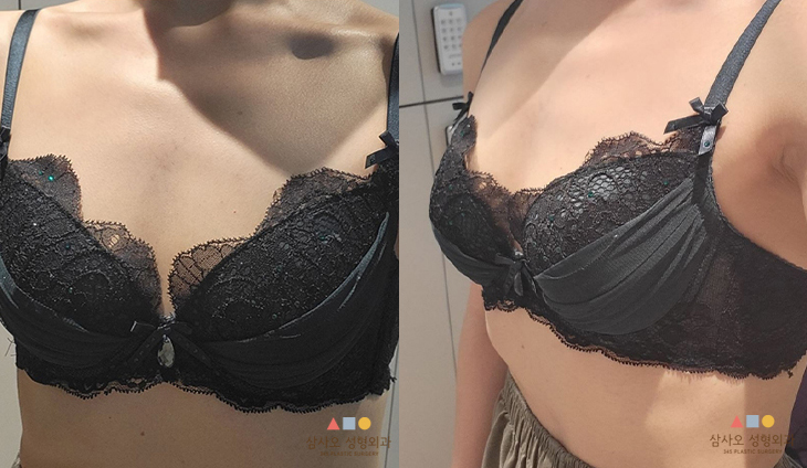 수술 전