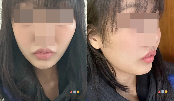 수술 후