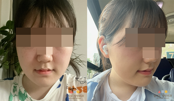 수술 후