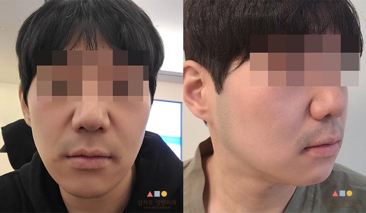 수술 전