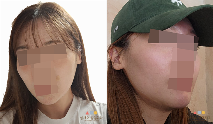 수술 전