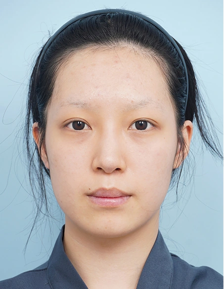 수술 전 정면 사진
