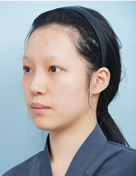 수술 전 45도 사진