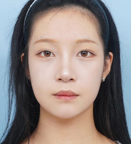 정면 82일 후