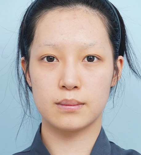 정면 수술 전