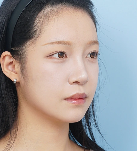 측면 82일 후