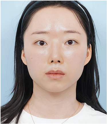 [ 정면 ] 안면윤곽3종(광대·사각턱·앞턱) + 앞턱 전진술 BEFORE