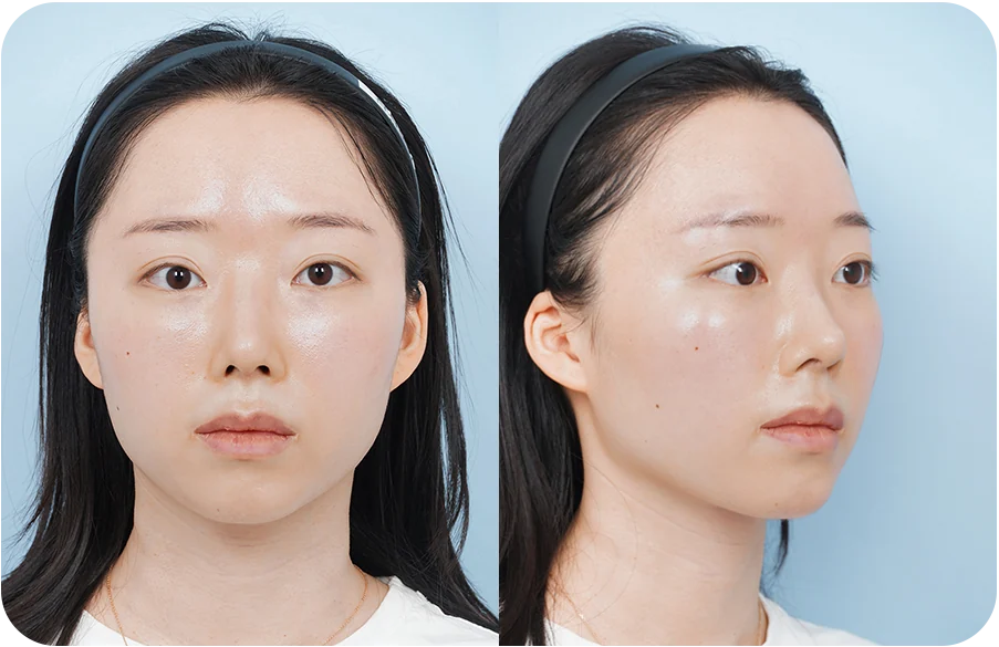 수술 전 정면·45도 사진