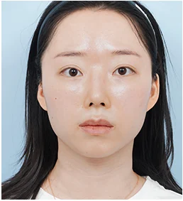 정면 수술전