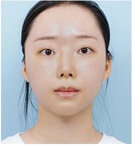 정면 14일 후