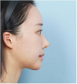 측면 30일 후