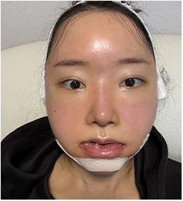 수술 1일 후 정면