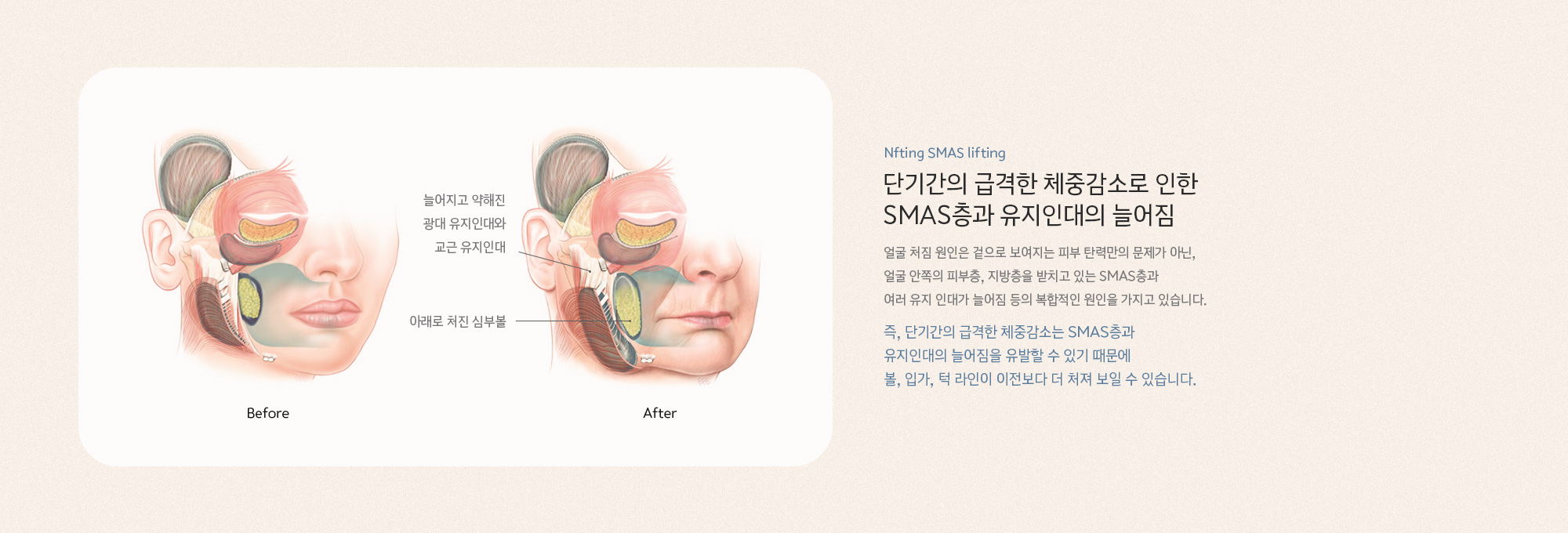 단기간의 급격한 체중감소로 인한 SMAS층과 유지인대의 늘어짐