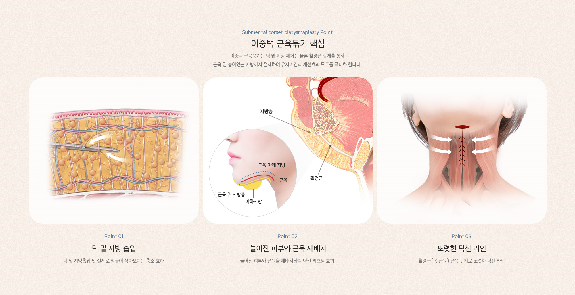 이중턱 근육묶기 핵심 이중턱 근육묶기는 턱 밑 지방 제거는 물론 활경근 절개를 통해 근육 밑 숨어있는 지방까지 절제하여 유지기간과 개선효과 모두를 극대화 합니다.
