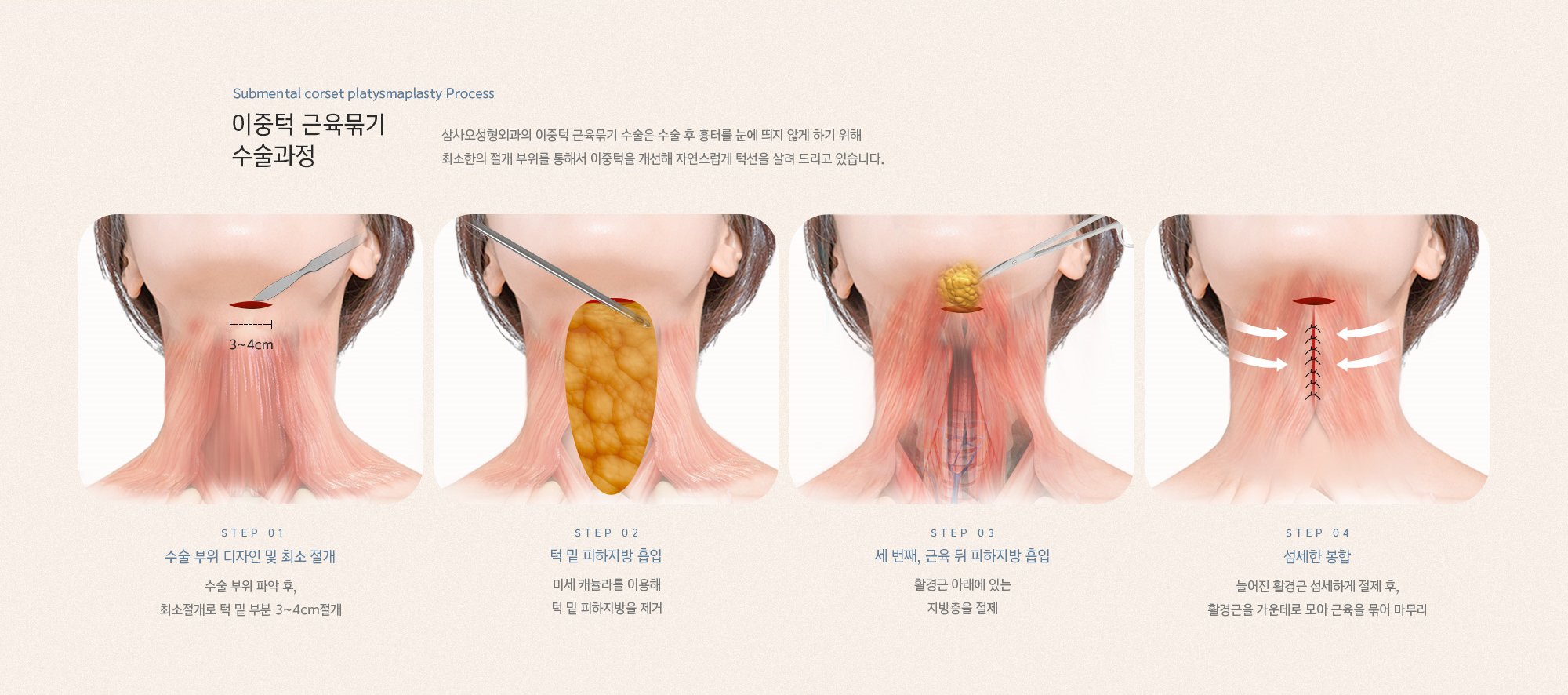 이중턱 근육묶기 수술과정 삼사오 성형외과의 이중턱 묶기 수술은 수술 후 흉터를 눈에 띄지 않게 하기 위해 최소한의 절개 부위를 통해서 이중턱을 개선해 자연스럽게 턱선을 살려 드리고 있습니다.