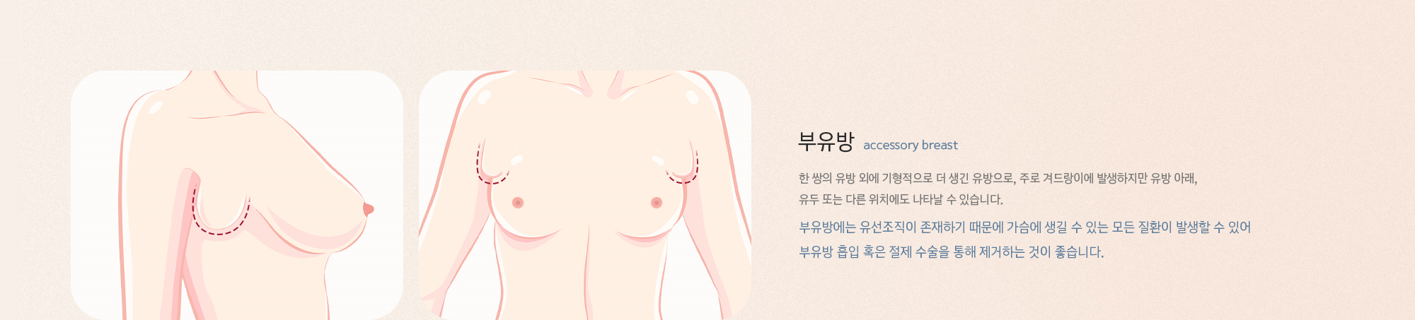 부유방, 한 쌍의 유방 외에 기형적으로 더 생긴 유방으로, 주로 겨드랑이에 발생하지만 유방 아래, 유두 또는 다른 위치에도 나타날 수 있습니다.