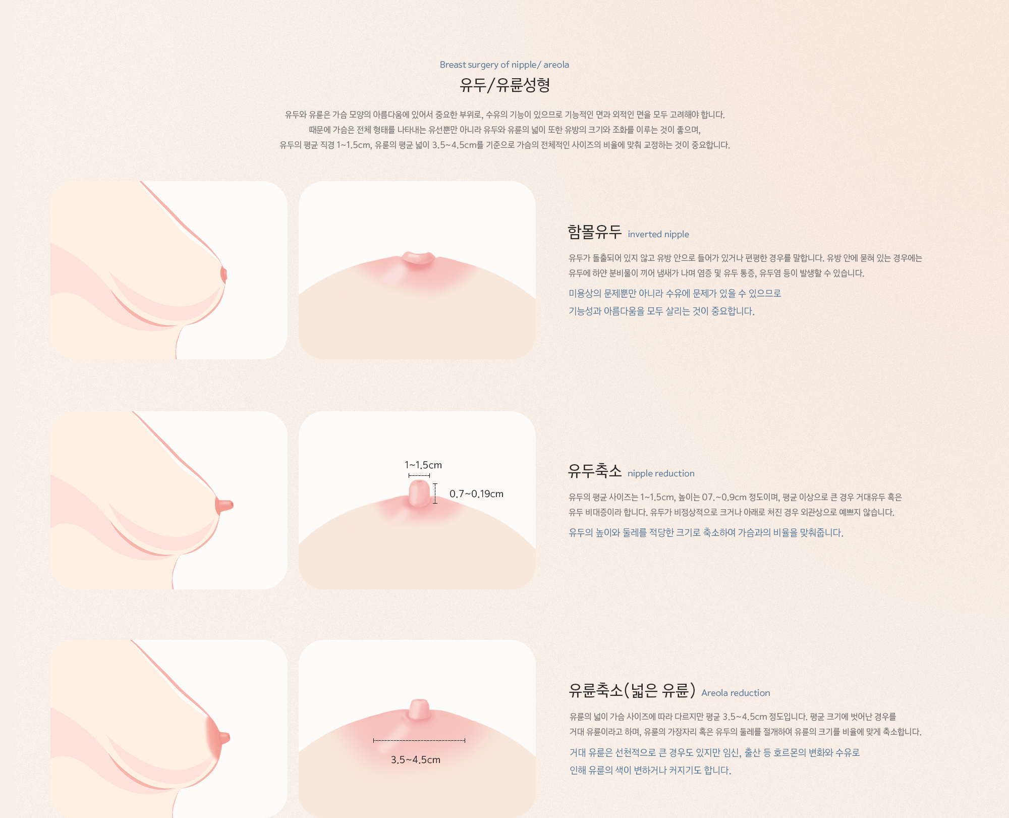 유두/유륜성형, 유두와 유륜은 가슴 모양의 아름다움에 있어서 중요한 부위로, 수유의 기능이 있으므로 기능적인 면과 외적인 면을 모두 고려해야 합니다. 때문에 가슴은 전체 형태를 나타내는 유선뿐만 아니라 유두와 유륜의 넓이 또한 유방의 크기와 조화를 이루는 것이 좋으며, 유두의 평균 직경 1~1.5cm, 유륜의 평균 넓이 3.5~4.5cm를 기준으로 가슴의 전체적인 사이즈의 비율에 맞춰 교정하는 것이 중요합니다.