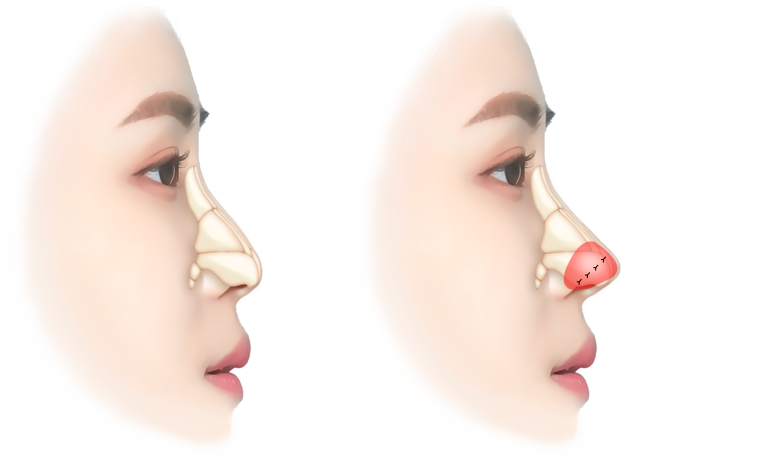 무보형물 코성형 Simulation 이미지